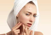 Мифы об акне: дерматолог из Уфы развеяла популярные заблуждения